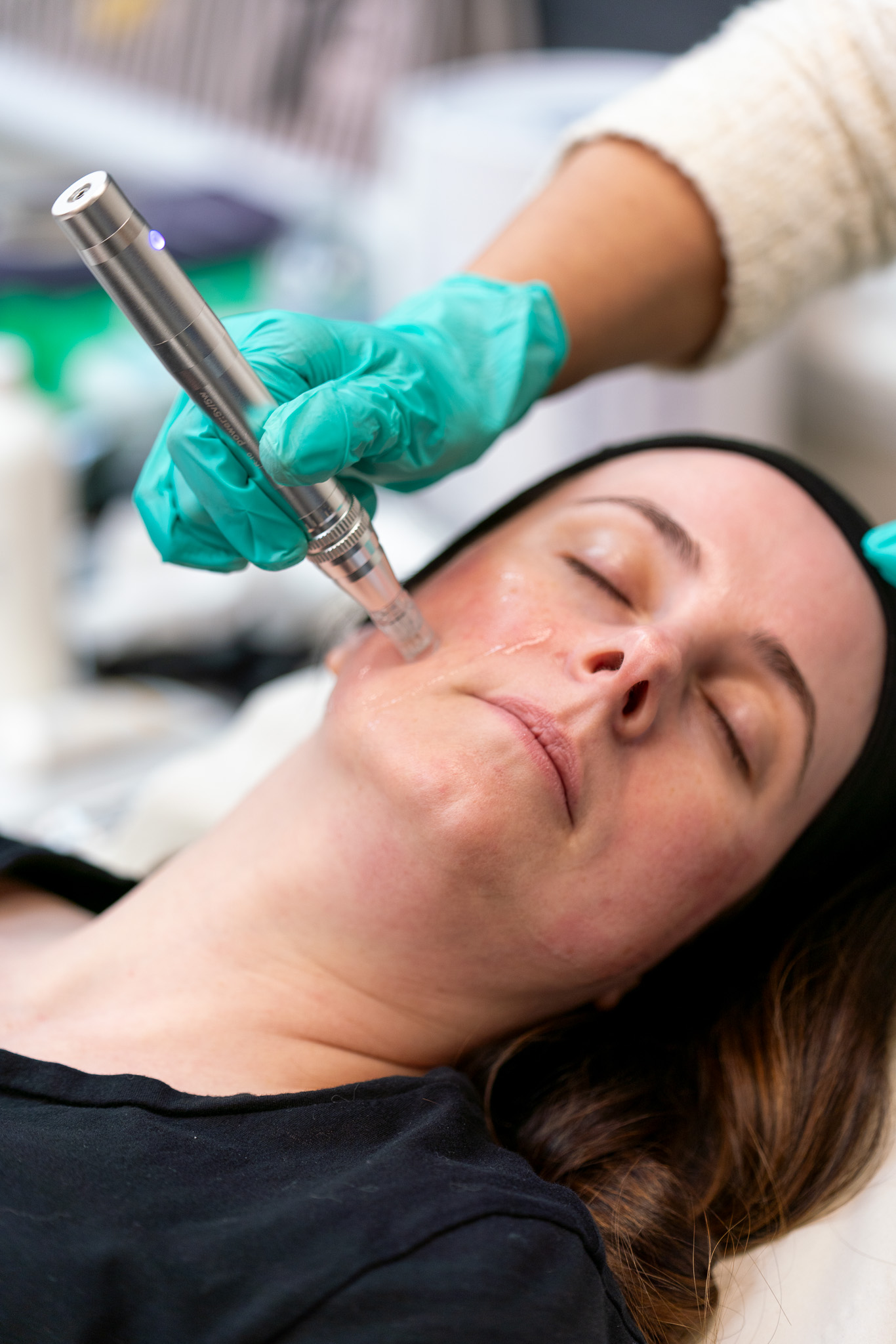 Microneedling RadioFrequency Together Vs Standalone Treatments Dr Sha 